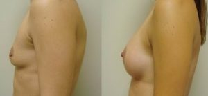 Lipofilling mammaire Turquie avant apres