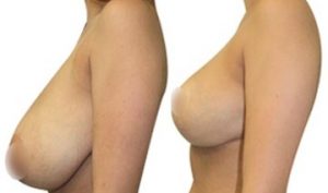 Réduction mammaire turquie avant apres