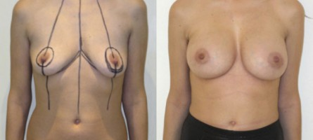 lifting mammaire avec implants